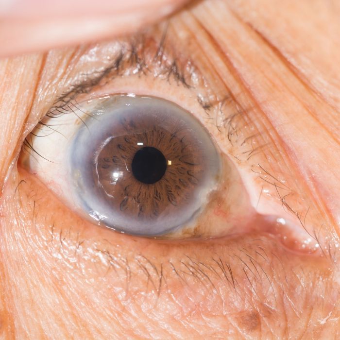 High cholesterol and the eyes signs and symptoms