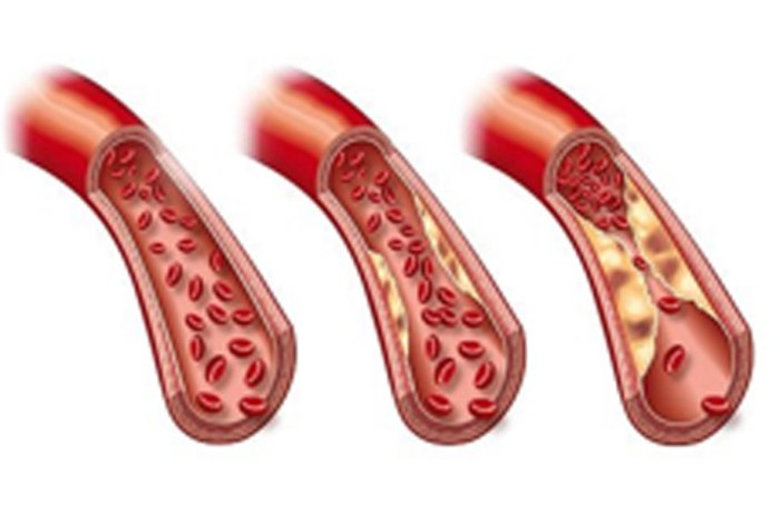 What are the causes of high triglycerides