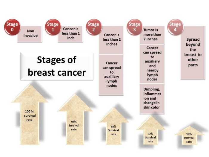 Stage 2 breast cancer