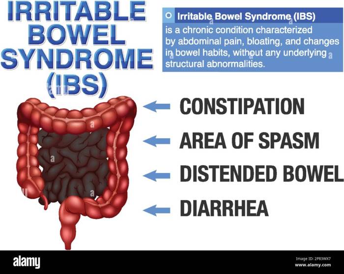 Irritable bowel syndrome ibs