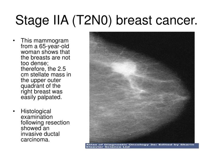 Stage 2 breast cancer