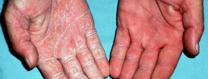 Tinea nigra symptoms causes diagnosis