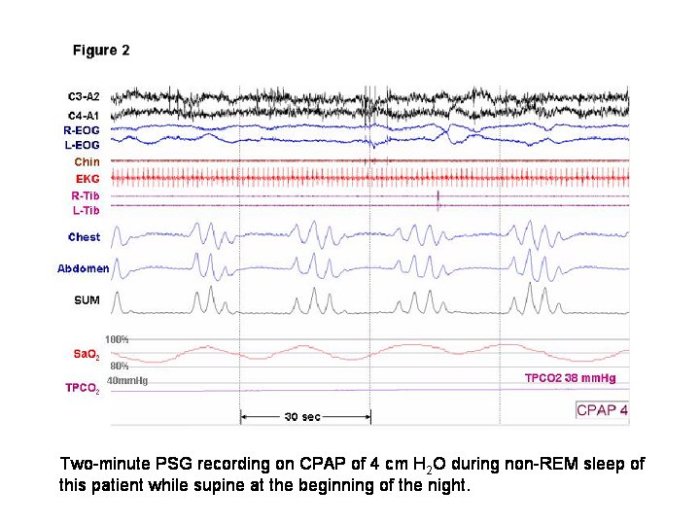 A Case of Complex Sleep Apnea? Are severe sleep apnea and cpap pressure correlated