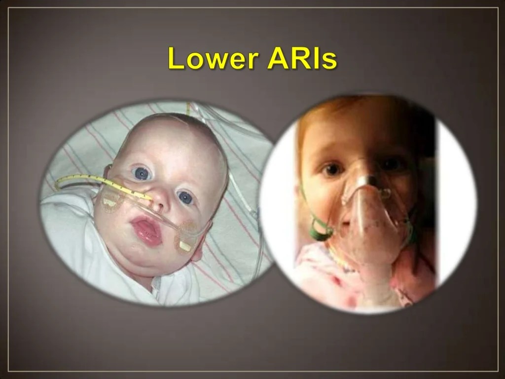 Recurrent respiratory infections in children