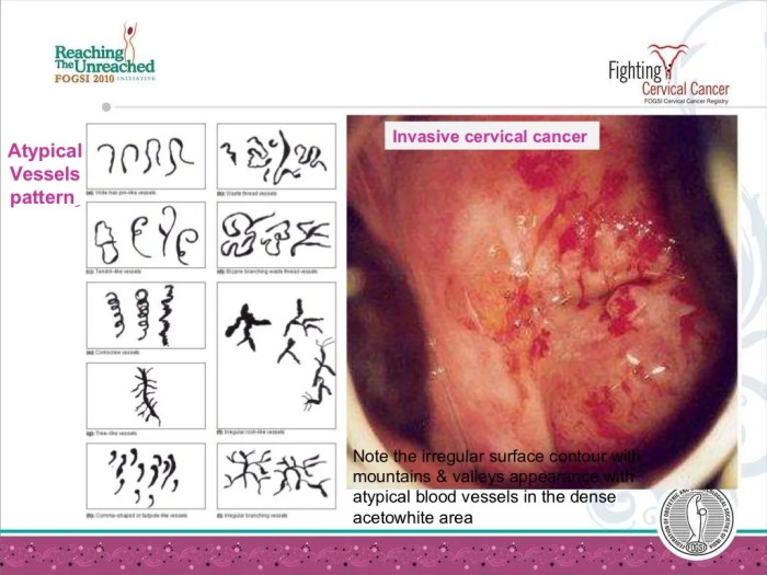 What is a Colposcopy? A Deep Dive
