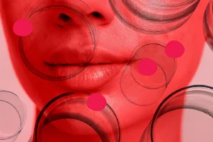 Can Changing Your Diet Really Clear Up Persistent Acne