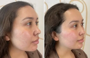 The Rise of XERF: Exploring the Science and Impact of South Korea’s Latest Non-Invasive Skin Tightening Innovation