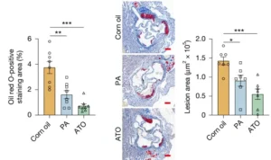 Gut Microbe-Produced Fatty Acid Acts as a Natural Statin to Combat Atherosclerosis, Study Reveals